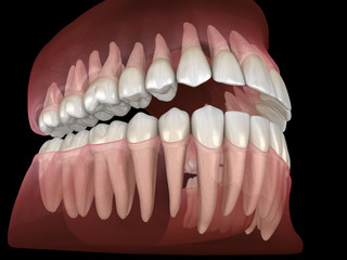 Morphology of mandibular and maxillary human gum and teeth. Medically accurate tooth 3D illustration