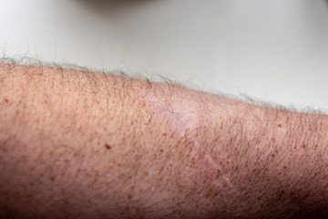 Naklejka premium old scar on hand