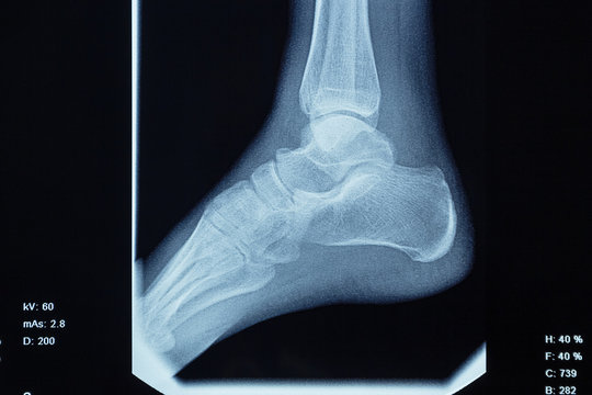 Detail of the x-ray of the bones of the human right foot