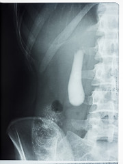 X-ray of the gallbladder and bones of the human vertical column.