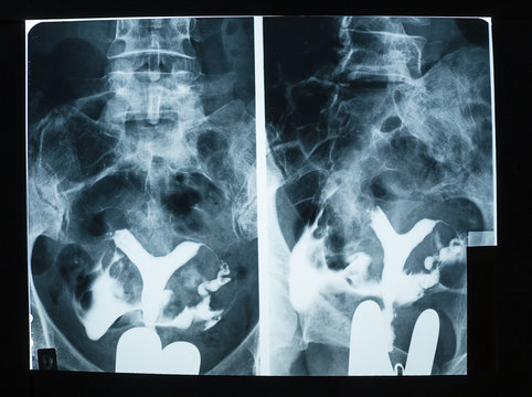 X-ray of pelvic bones and human spine.