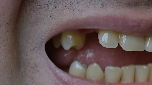 Close-up of a man opening his mouth and showing the absence of some teeth.