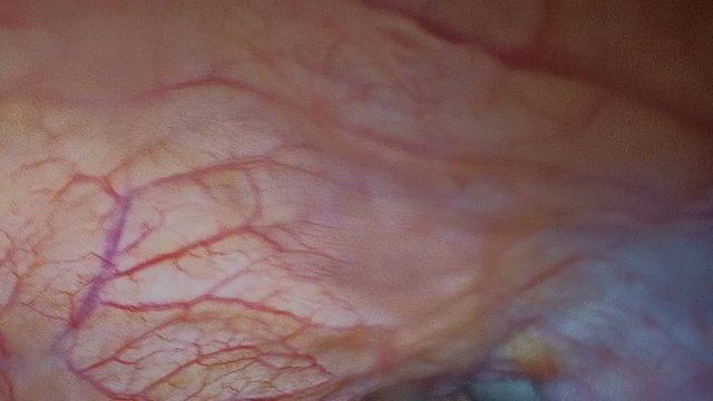 Endovideosurgery. Laparoscopy. View video camera inside the abdominal cavity of a sick patient.