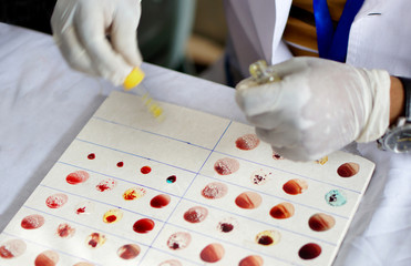 Doctor check blood group of patient or donor by mixing the sample with reagent