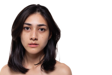 Beautiful asian woman gets freckles, blemish, pimple or acne and dull skin on her face. Charming...