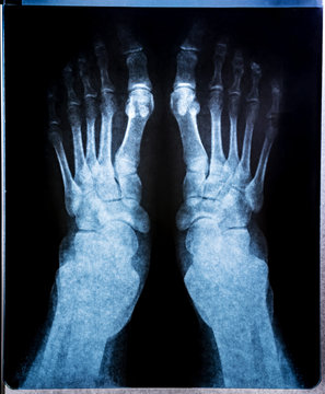 X-ray image of joint foot. Research on the computed tomography