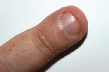 finger nail biting on white background