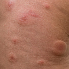 The traces of mosquito bites on human skin. On the need to protect against mosquitoes.