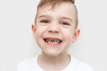 Close up shot of a boy teeth with caries. Health care, dental hygiene and childhood concept. Dental problems