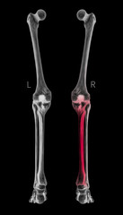 X-ray of Human Leg bone left and right- Posterior view red highlights in Tibia bone pain area-3D Medical and Biomedical illustration-Healthcare-Human Anatomy and Medical Concept- Black and white color