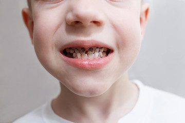 Close up shot of a boy teeth with caries. Health care, dental hygiene and childhood concept. Dental problems