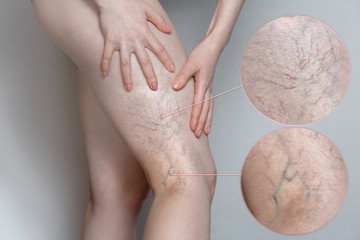 Woman shows leg with varicose veins. Magnifying the image. The concept of human health and disease