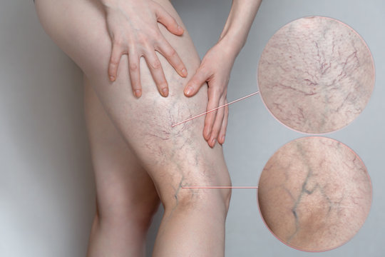 Woman Shows Leg With Varicose Veins. Magnifying The Image. The Concept Of Human Health And Disease