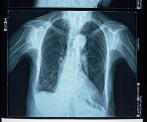 X-ray of the human thorax.