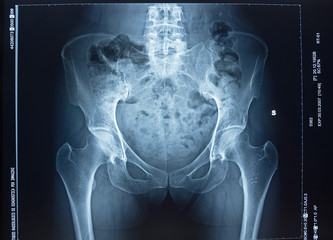 X-ray of pelvic bones and human spine.