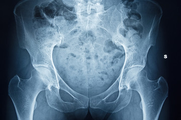 X-ray of pelvic bones and human spine.
