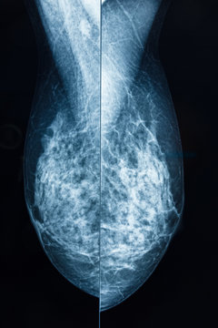 Mammography, for breast cancer prevention.