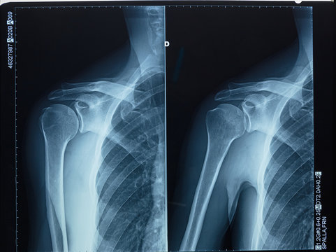Detail of x-ray of human shoulder bones