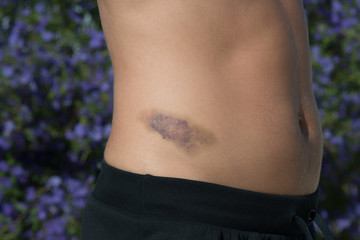 Detail of big bruise on man body