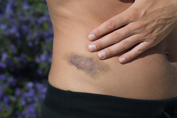 Detail of big bruise on man body