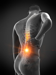 Plakat 3d rendered medically accurate illustration of a mans painful back