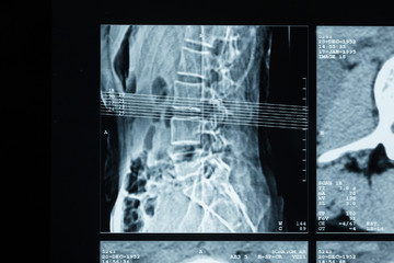 T.A.C. Computerized axial tomography of the lumbar spine, human.
