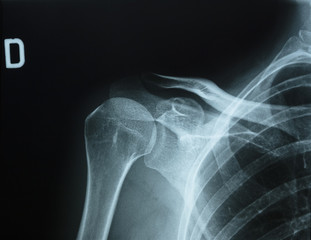Detail of x-ray of human shoulder bones