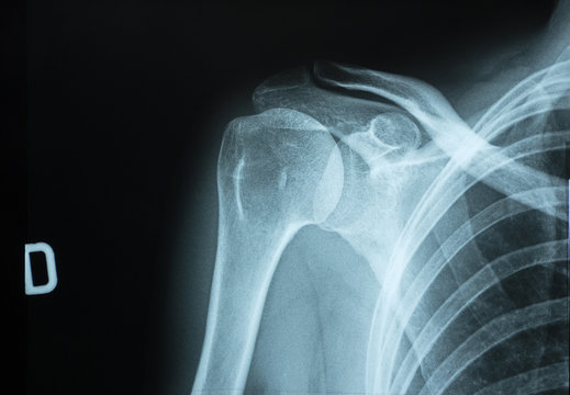 Detail of x-ray of human shoulder bones