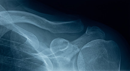 Detail of x-ray of human shoulder bones