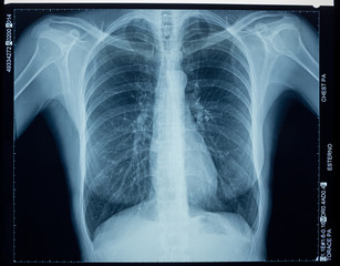 X-ray of the human thorax.