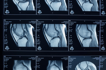 R.M.N. Nuclear magnetic resonance, of human knees, with cross-section and sagittal section.