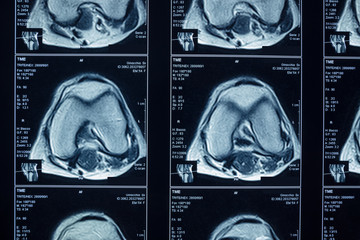 R.M.N. Nuclear magnetic resonance, of human knees, with cross-section and sagittal section.