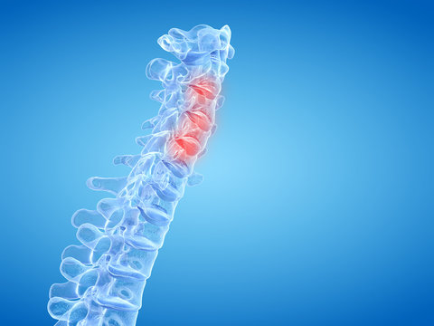 3d rendered medically accurate illustration of painful intervertebral discs