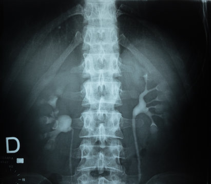 Urography with contrast fluid and x-ray of the bones of the human spine.