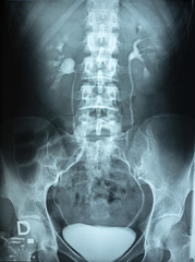 Urography with contrast fluid and x-ray of the bones of the human spine.