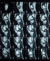 R.M.N. Nuclear magnetic resonance, of human knees, with cross-section and sagittal section.