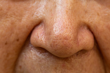 Acne, Small pimple is on senior woman's nose, Deep groove cheeks, Close up and macro shot, Selective focus, Asian Body skin part, Healthcare and Beauty concept