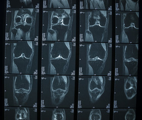 R.M.N. Nuclear magnetic resonance, of human knees, with cross-section and sagittal section.