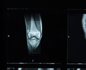 Detail of the x-ray of the bones of the human knee