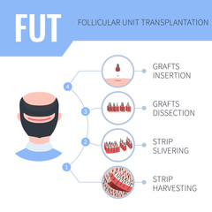 Hair transplantation alopecia treatment by FUT in men. 4 steps infographics. Stages of follicular unit transplantation restoration surgery for male patients. Vector template for clinics.