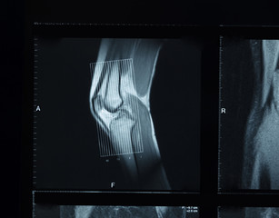 Detail of the x-ray of the bones of the human knee