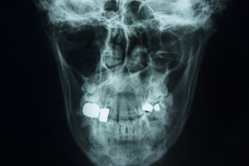 X-ray, in front of the human skull.