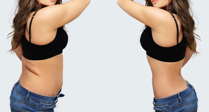 Weight Loss, Diet, Abdominoplasty.