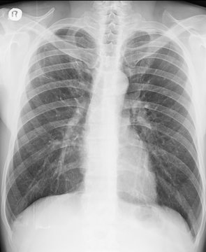 Chest X-ray. PA view. Lung fields with persistent pulmonary opacities.  Hemidiaphragms: sharp, and clearly delineated. Phrenicocostal sinuses are clear. Normal anatomy of pulmonary vessels.