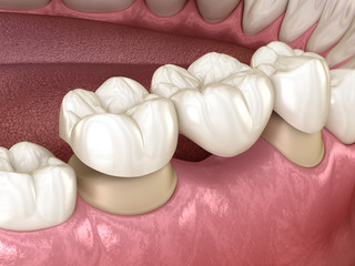 Dental bridge of 3 teeth over molar and premolar. Medically accurate 3D illustration of human teeth treatment