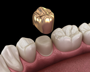 Golden crown premolar tooth assembly process. Medically accurate 3D illustration of human teeth treatment