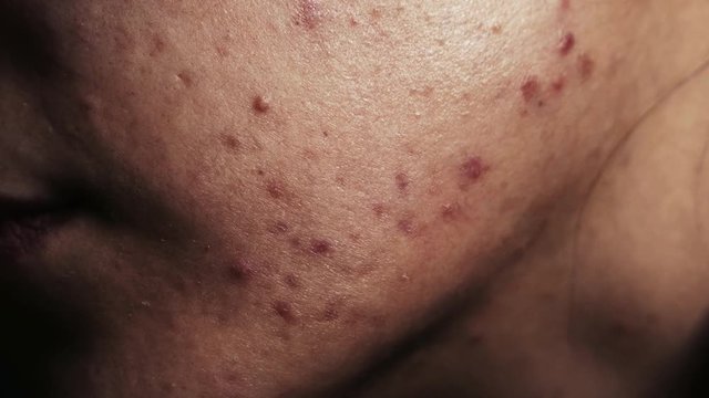 Severe Acne on Chin - Macro closeup in 4k