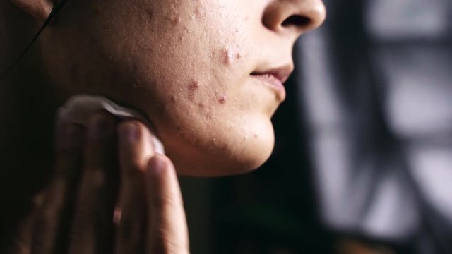 Cleaning Acne with cream - In hope of Cure - Close up in 4K