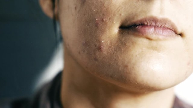 Skin problem - Acne on the face of women - Macro in 4k