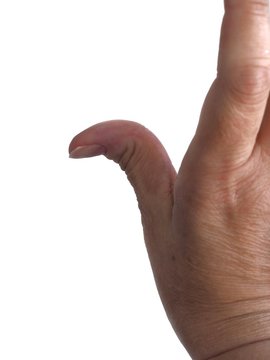 A curved hypermobile thumb